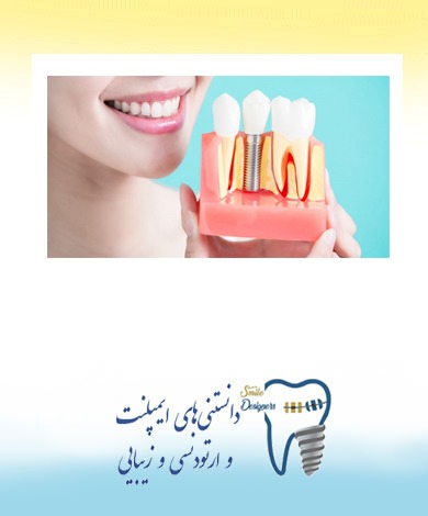 جراحی کاشت ایمپلنت دندان توسط  فوق تخصص ایمپلنت در تهران
