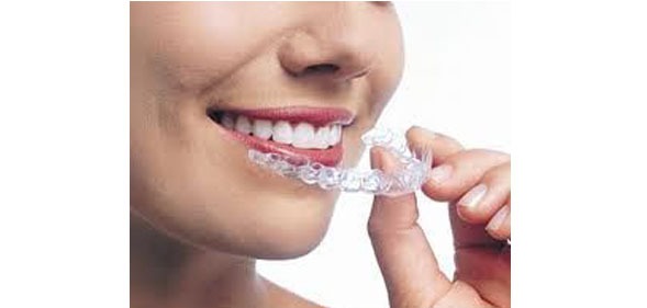 در این روش نو پدید درمان ارتودنسی ، متخصص ارتودنسی از پلاک های شفاف  برای ردیف کردن دندان ها استفاده می شود.