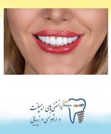 درمانهای زیبایی در دندانپزشکی -قسمت دوم