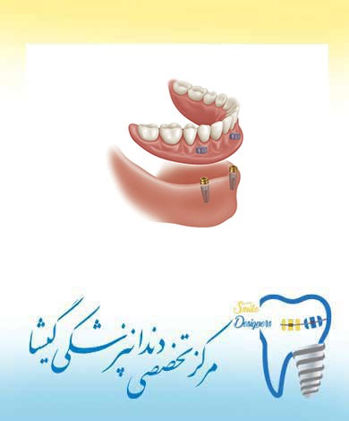 اوردنچر متکی بر ایمپلنت های دندانی توسط متخصص ایمپلنت در تهران