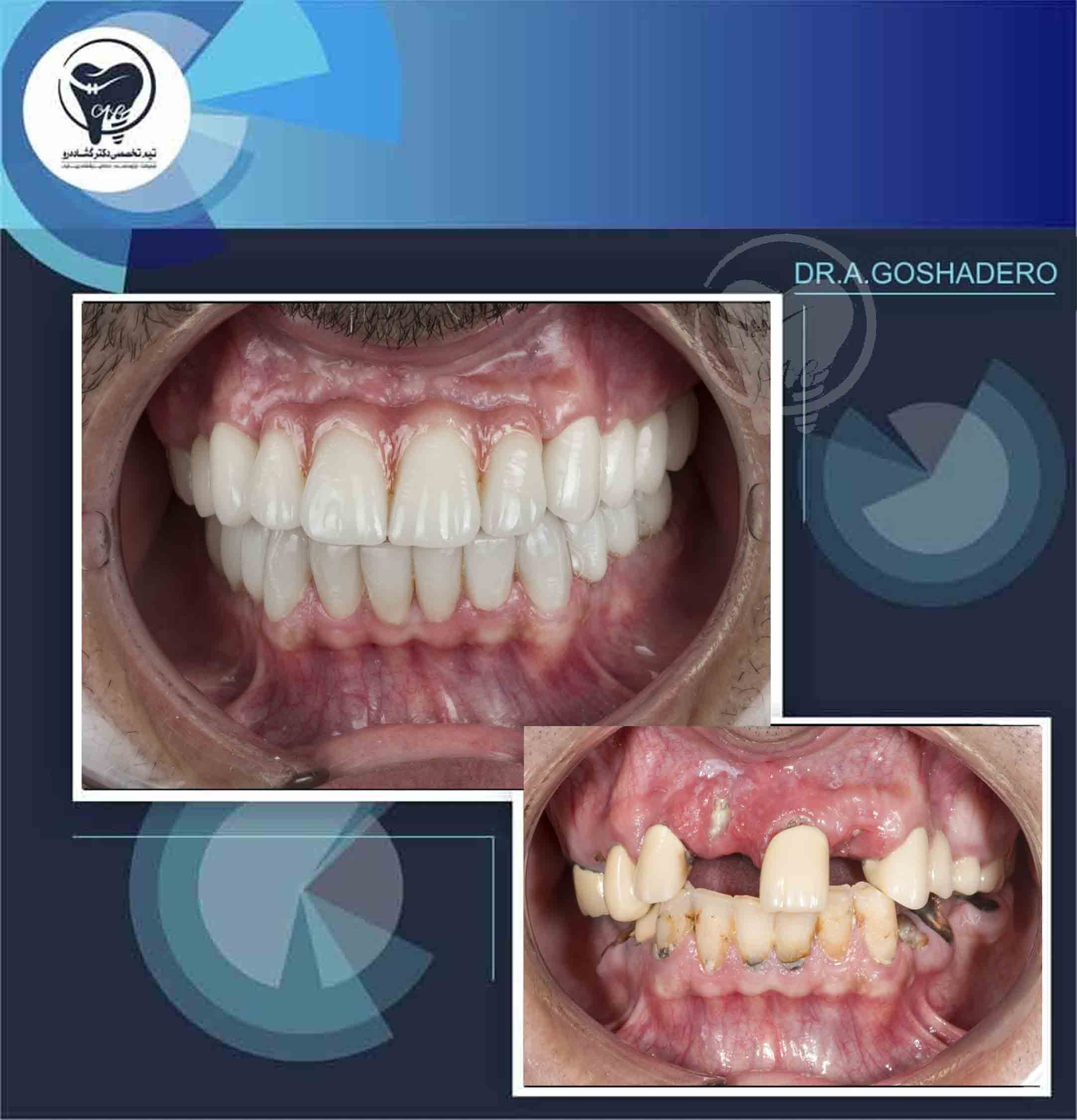 نمونه درمان ایمپلنت دندان