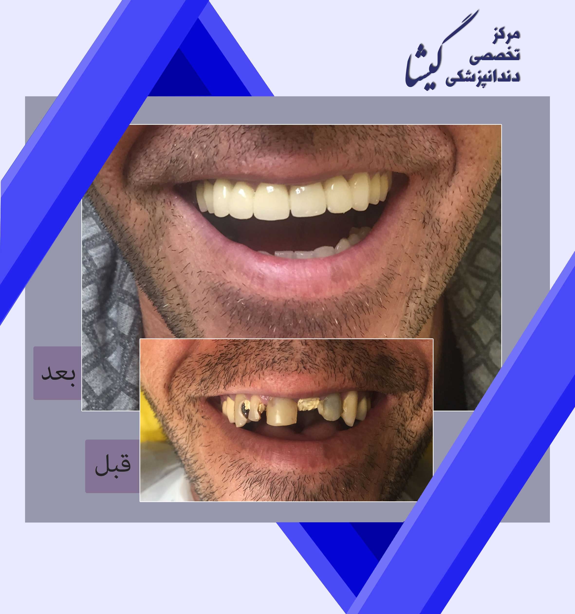 بازسازی دندانهای جلویی به شدت پوسیده با روکشهای زیرکونیا و لبخند صمیمانه بیمار عزیزمان! لبخند شما تخصص ماست.