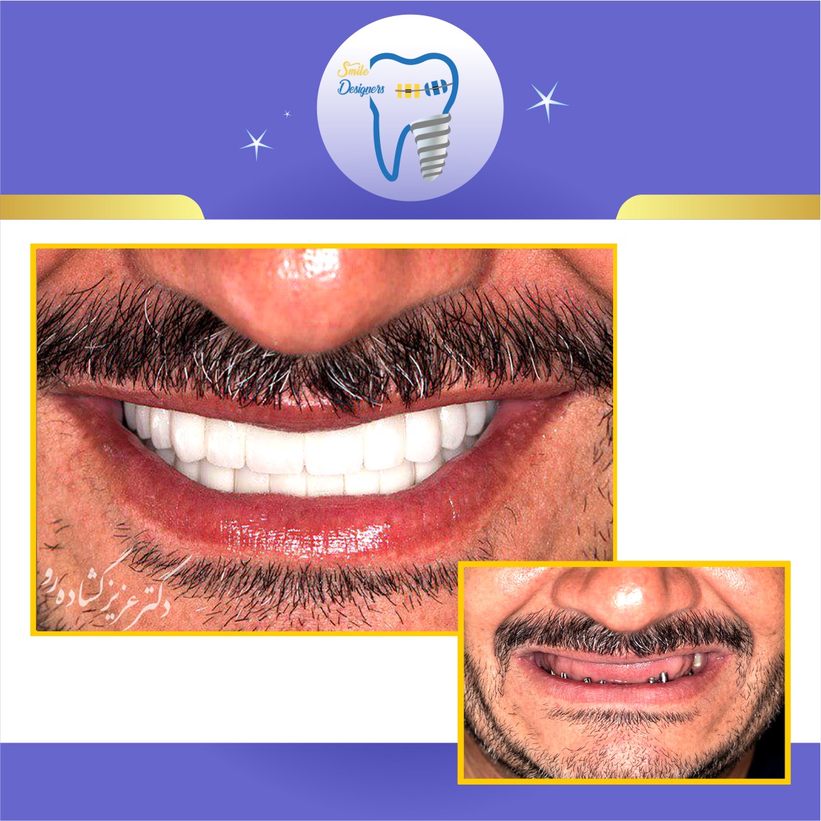 درمان ایمپلنت دندانها توسط متخصص ایمپلنت و پروتز در تهران( دکتر عزیز گشاده رو ، متخصص ایمپلنت و پروتز دندان ، استاد دانشگاه شهید بهشتی، رتبه اول بورد کشور)