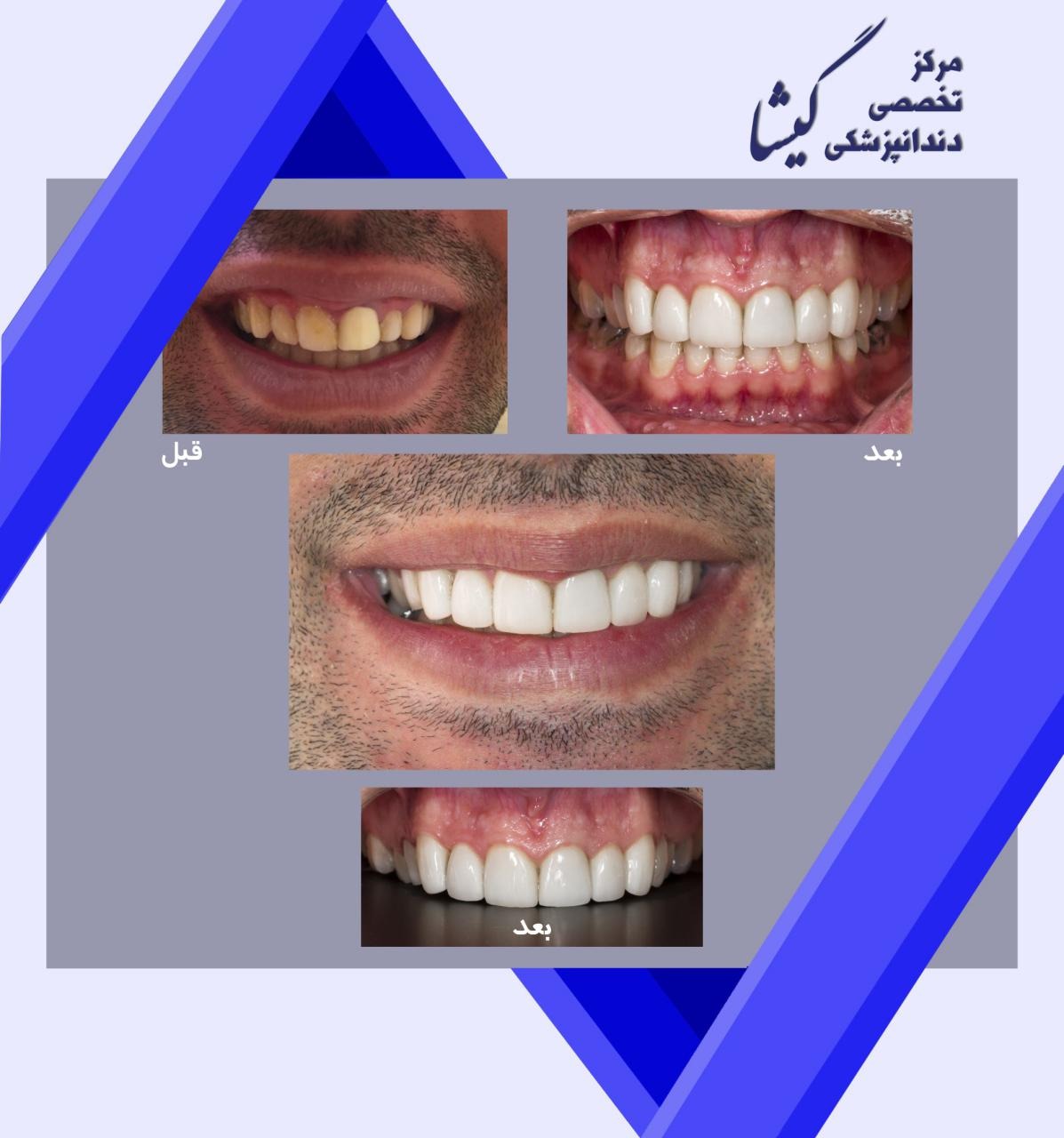 لمینت سرامیکی توسط متخصص پروتزهای دندانی و زیبایی در تهران