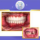 درمان ایمپلنت دندانها توسط متخصص ایمپلنت و پروتز در تهران( دکتر عزیز گشاده رو ، متخصص ایمپلنت و پروتز دندان ، استاد دانشگاه شهید بهشتی، رتبه اول بورد کشور)