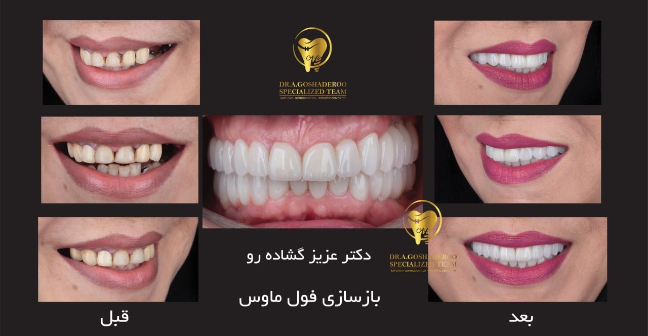 روکش