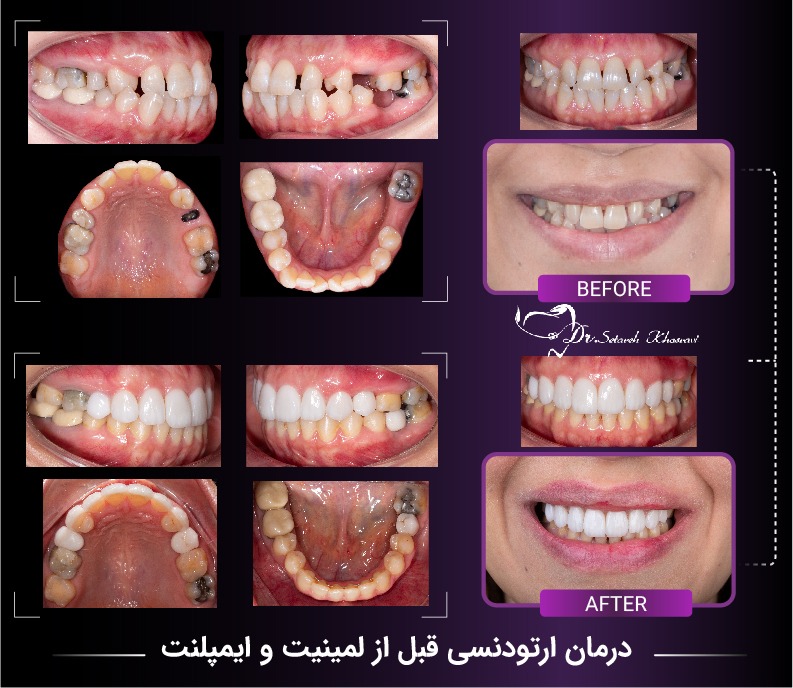 نمونه درمان ارتو