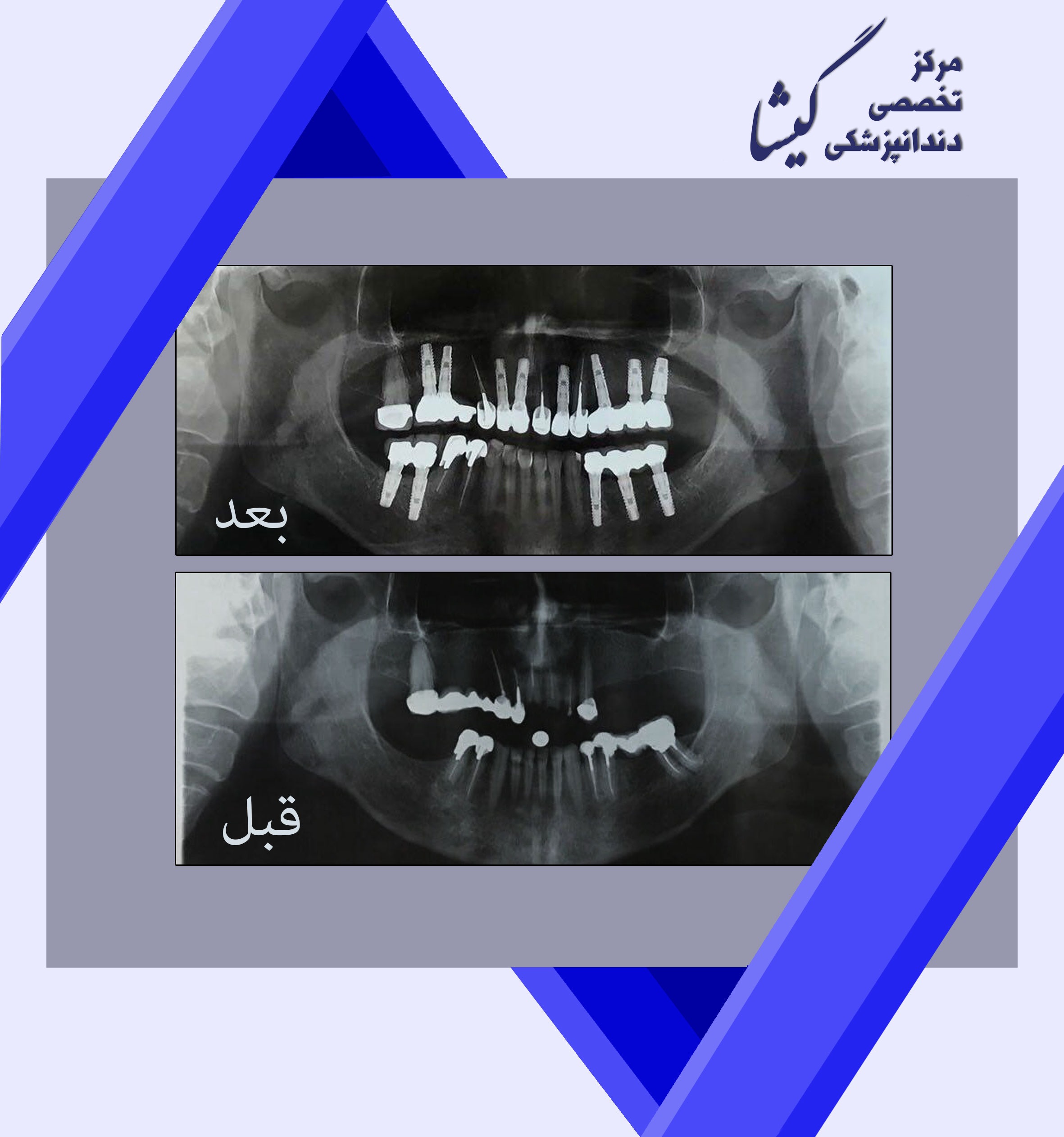 درمان ایمپلنت در بیماری که  داراي دندانهای جلویی تخریب شد.