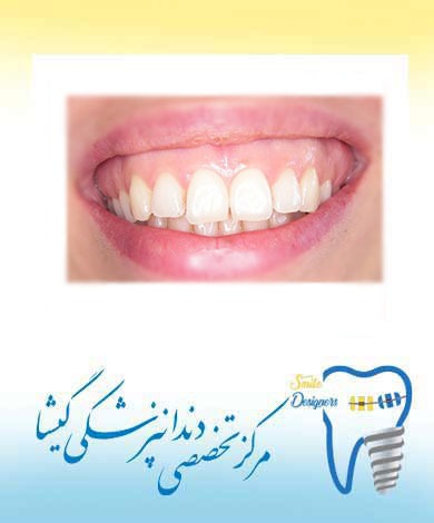 لبخند لثه ای و درمان آن توسط متخصص زیبایی دندان در تهران