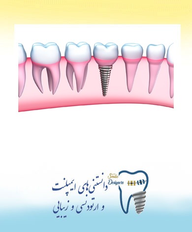 مراقبت های پس از ایمپلنت (کاشت دندان)