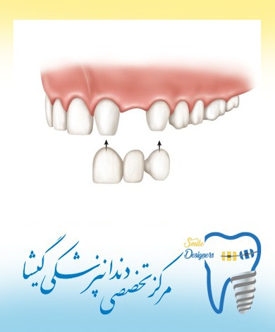 ایمپلنت دندان بهتر است یا بریج دندان؟