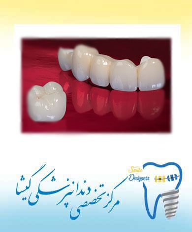 انواع روکش های تمام سرامیک توسط متخصص پروتزهای دندانی و ایمپلنت در تهران:
