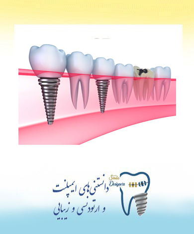 Immediate dental implants placement by the best implant specialist in Tehran