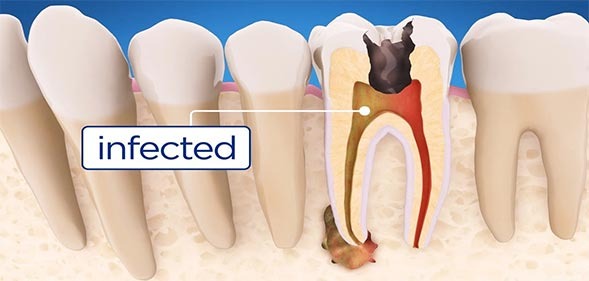 دندان از بخش‌های مختلفی تشکیل شده است. به ‌طور کلی لایه ‌های تشکیل دهنده دندان به ترتیب از بیرون به داخل عبارتند از مینا، عاج و پالپ. پالپ حاوی رگهای خونی و عصبی می‌باشد.بهتر است توسط دندانپزشک متخصص  درمان ریشه  دندان انجام شود.