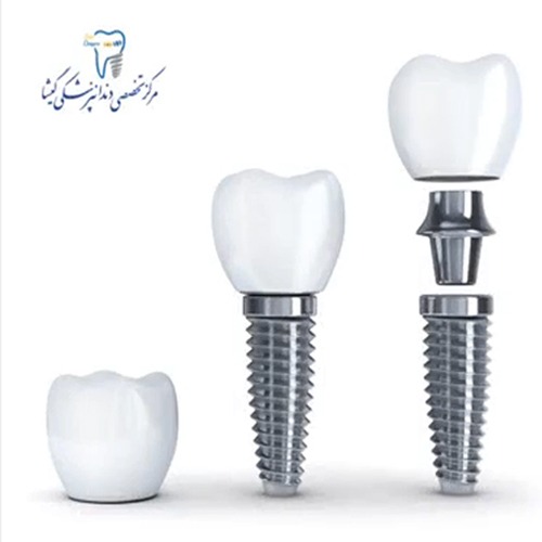 اهمیت ایمپلنت دندان