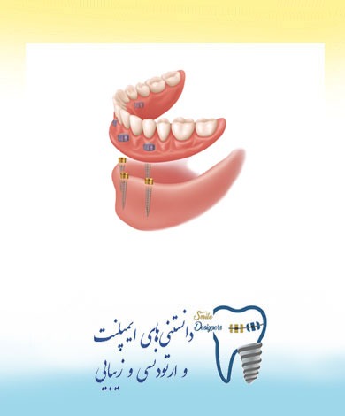 توصیه های متخصص پروتزهای دندانی و ایمپلنت در تهران در مورد بهداشت اوردنچر متکی بر ایمپلنت
