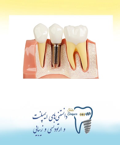 کاشت ایمپلنت دندان در افراد سیگاری