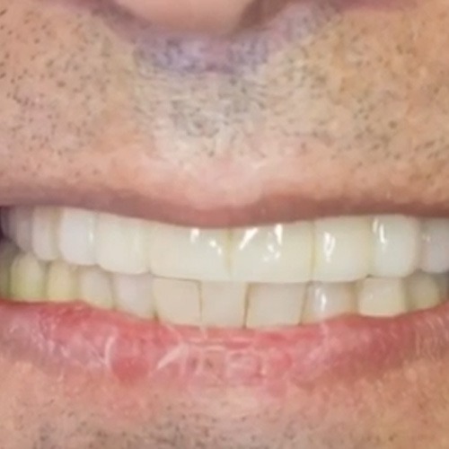بازسازی کامل دندانهای فک بالا و دندانهای عقبی فک پایین با ایمپلنت