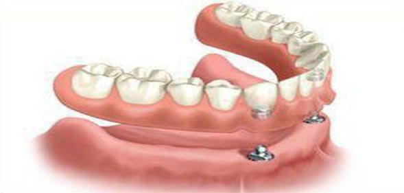 هنگامی که تمام دندان‌های طبیعی خود را از دست میدهید، یکی از روش‌های متداول برای جایگزینی استفاده از دندان مصنوعی کامل است. دندان مصنوعی کامل شامل تمام دندان‌های یک قوس دندانی می‌شود .بهتر است توسط دندانپزشک متخصص   پروتز های دندانی و ایمپلنت  و زیبایی انجام شود.