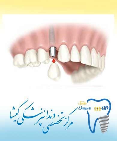مراحل کاشت ایمپلنت دندان توسط متخصص ایمپلنت در تهران