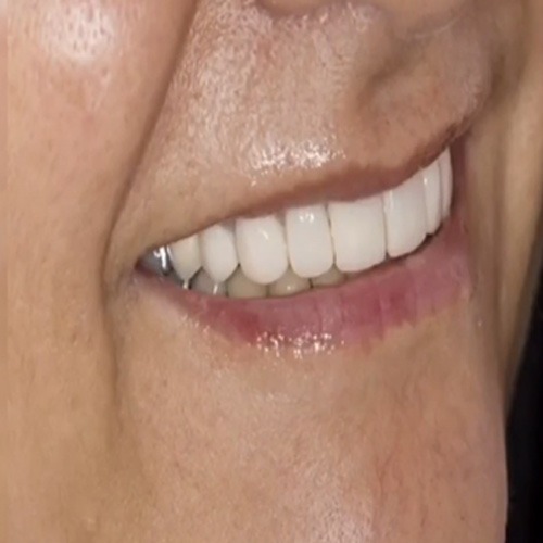 لامینیت سرامیکی ۸ دندان جلویی فک بالا توسط متخصص پروتز های دندانی و زیبایی