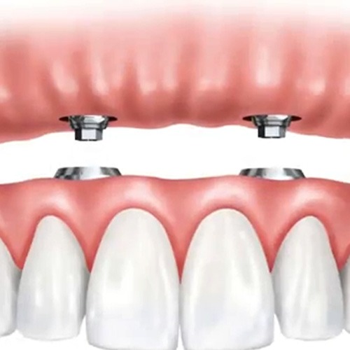درمانهای تخصصی متخصص پروتز های دندانی و ایمپلنت