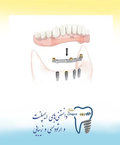 نکات مهم در کاشت ایمپلنت دندان از نظر متخصص ایمپلنت در تهران