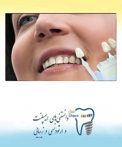 لمینت یا کامپوزیت دندان ؟
