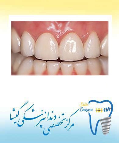 لامینیت سرامیکی توسط متخصص پروتزهای دندانی و ایمپلنت در تهران:
