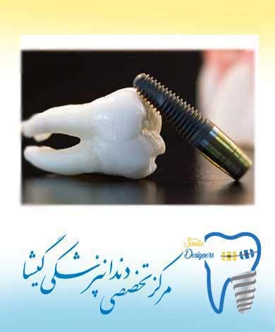 مضرات ، معایب و عوارض ایمپلنت دندانی