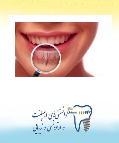 مراقبت‌های پس از عمل جراحی کاشت ایمپلنت دندان