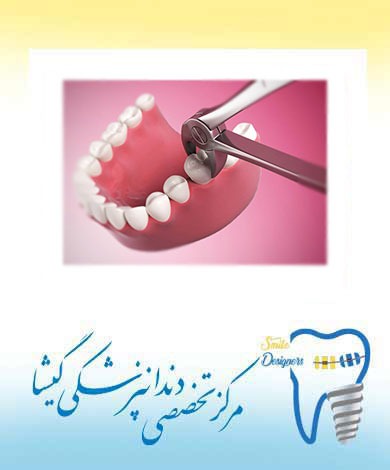 توضیحات متخصص پروتز های دندانی و ایمپلنت در مورد تاثیر کشیدن دندان ها بر کیفیت زندگی