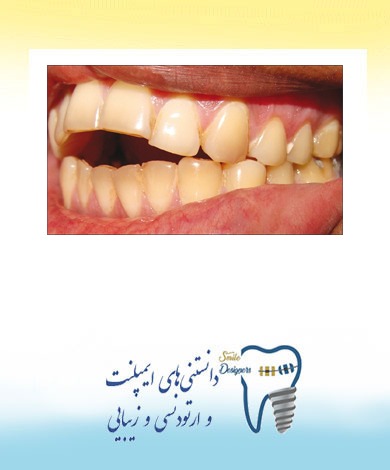 درمانهای اپن بایت یا به هم نرسیدن دندانهای جلویی در بزرگسالان