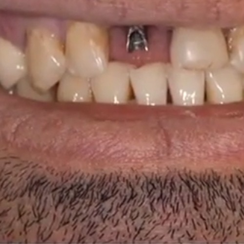 مراحل درمان ایمپلنت دندان جلو