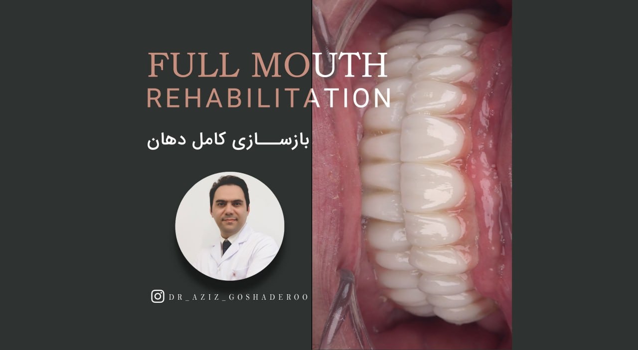 بازسازی کلیه دندانهای بالا و پایین با پروتزهای ثابت متکی بر ایمپلنت توسط بهترین متخصص ایمپلنت تهران