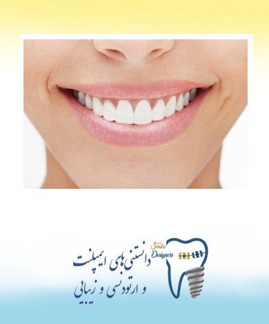 لامینیت های سرامیکی  بدون تراش توسط متخصص پروتزهای دندانی و ایمپلنت وزیبایی در تهران