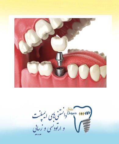 مراحل جایگزینی ایمپلنت دندان توسط دندانپزشک متخصص ایمپلنت در تهران