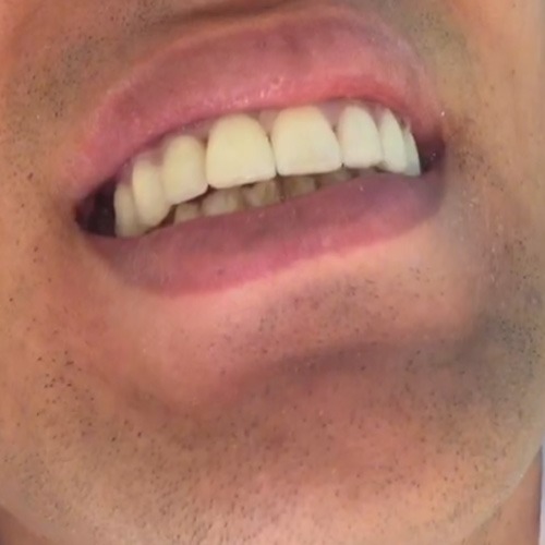 روكش تمام سراميك متكی بر ايمپلنت و لامينيت  توسط متخصص پروتزهای دندانی در غرب تهران