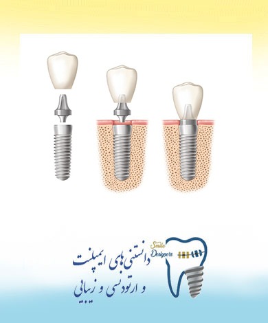 مزیتهای ایمپلنت(کاشت دندان) بر بریج و دندان مصنوعی متحرک