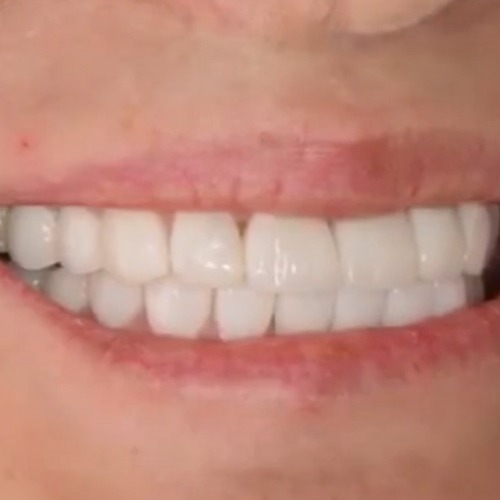 بازسازی دندانها با ایمپلنت و لامینیت سرامیکی
