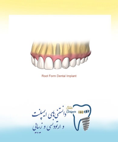 آشنایی با اشکال مختلف ایمپلنت دندان