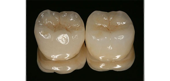 همانطور که از نام آن بر می آید ،روکشهای تمام سرامیک به طور کامل از نوعی چینی مانند پرسلن ساخته شده است. و بهتر است توسط متخصص پروتزهای دندانی و ایمپلنت درمان شوند.