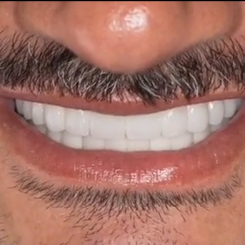 بازسازی کامل دندانها با ایمپلنت در فردی با مشکل پریودنتال پیشرفته