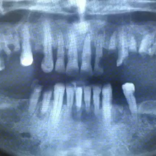 ایمپلنت کل دندانها در فردی با بی دندانی کامل توسط متخصص ایمپلنت در تهران