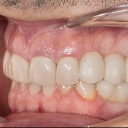 بازسازی دندانهای بیمار عزیزمان با ایمپلنت دندان و روکش