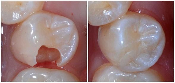 ترمیم زیبایی دندان توسط دندانپزشک زیبایی در غرب تهران