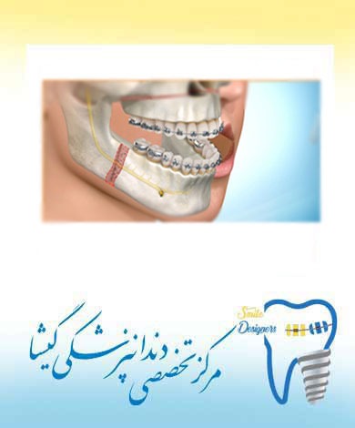 تجویز جراحی چانه در بيماران ارتودنسی توسط متخصص ارتودنسی در تهران