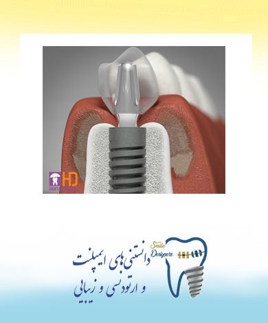 شرایط لازم برای کاشت ایمپلنت فوری بلافاصله پس از کشیدن دندان