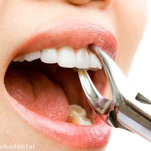 همه چیز در مورد ایمپلنت دندان
