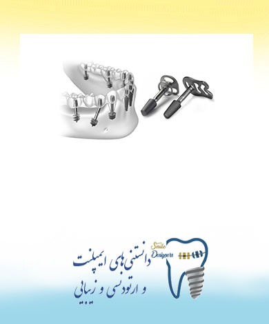 مزیت‌های بارگذاری فوری ایمپلنت دندان و ایمپلنتهای قاعده ای